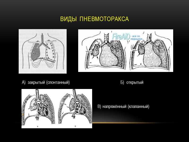 Виды  пневмоторакса А)  закрытый (спонтанный)       